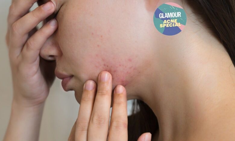 Hormonal Acne: Expert Advice For How To Get Rid Of It & Real Life Story