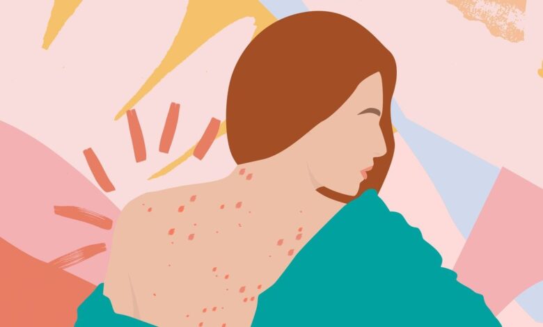 How to get rid of back acne fast, according to skin experts