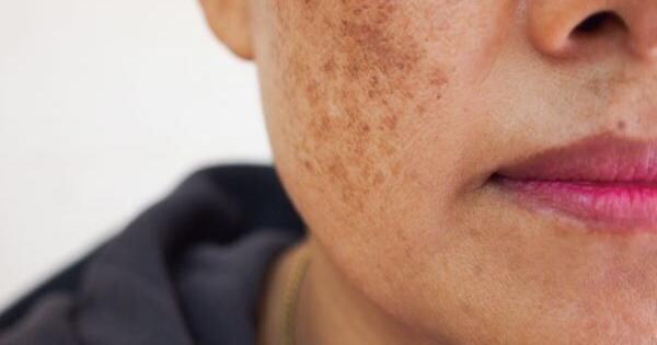 New Dark Patches or Freckling -- A Dermatologist Offers Tips on Dealing With It