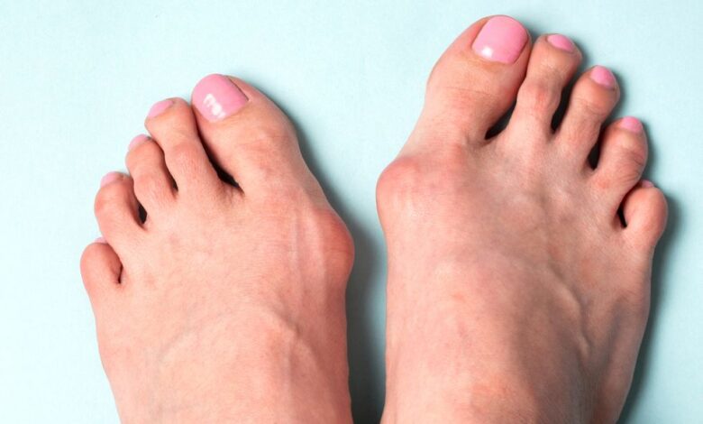 feet with bunions