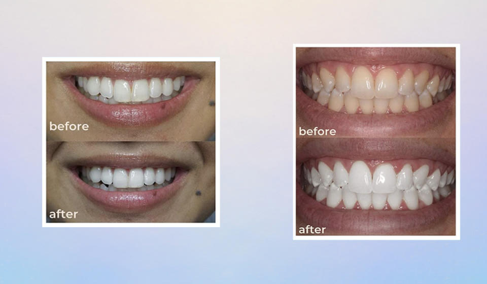 Side-by-side comparison of teeth whitening treatment before and after